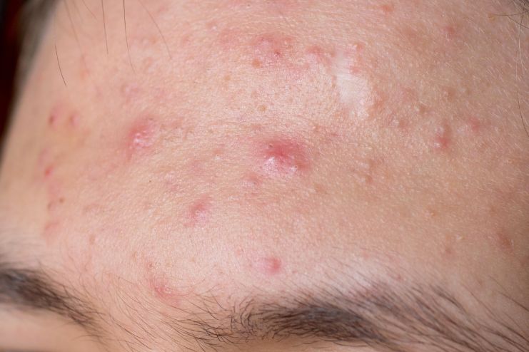 What Is Fungal Acne