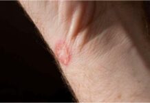 Ringworm Explained: Causes, Symptoms, Stages, and the Best Diet for Faster Healing Ringworm or tinea fungal infection