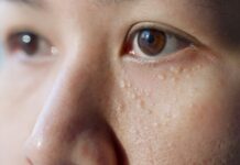 What Causes Milia? Tiny Bumps That Look Like Whiteheads but Aren’t What Causes Milia