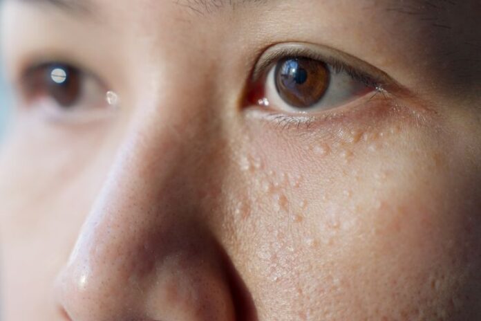 What Causes Milia