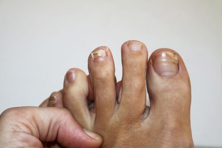 Brittle or Splitting Nails
