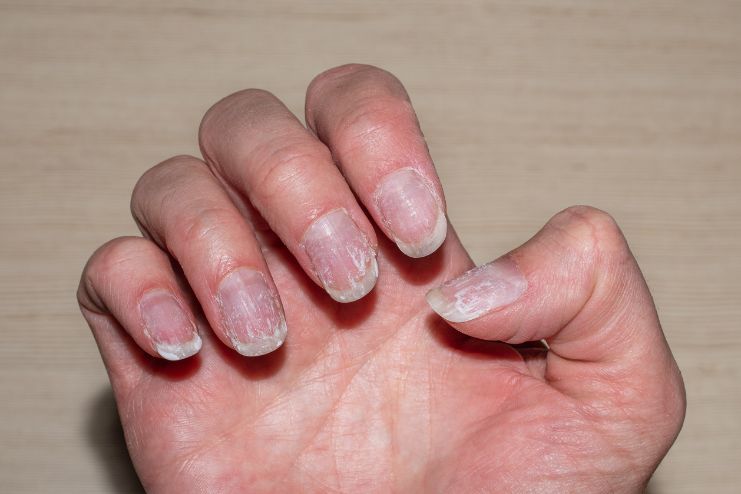 Pitted Nails