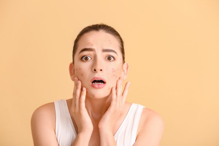 Skin Problems Adult Acne Sensitivity Pigmentation