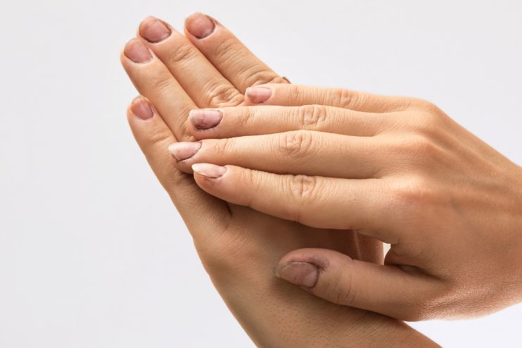 Spoon-Shaped Nails Koilonychia