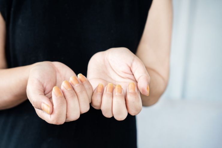 Thickened or Yellow Nails