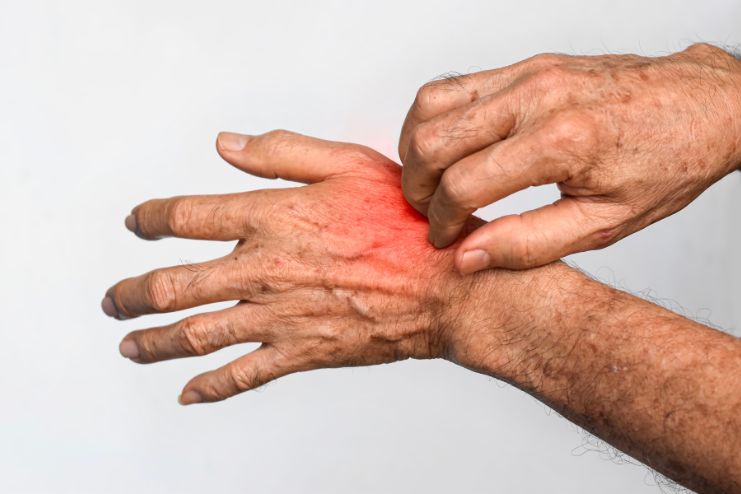 Major Symptoms of Scabies