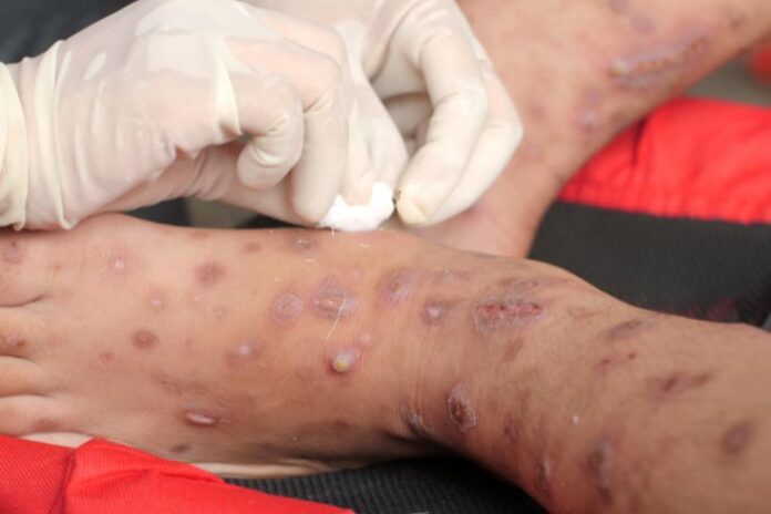 Scabies In Humans Scabies In Humans