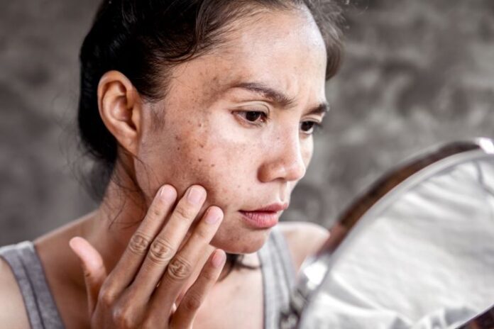 Hacks to Get Rid of Skin Blemishes Hacks to Get Rid of Skin Blemishes