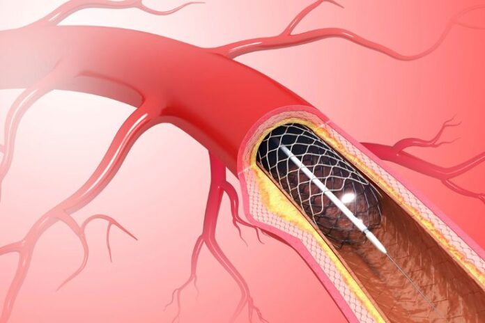 Heart Stents After 10 Years
