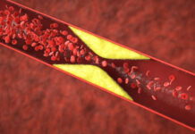 Can You Reverse Early Plaque Buildup in Arteries Naturally? Can You Reverse Early Plaque Buildup in Arteries Naturally