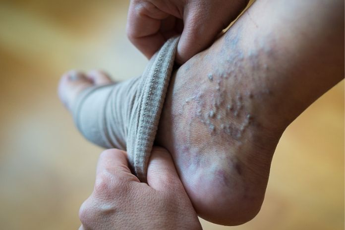 Leg and Muscle Symptoms Associated with Impaired Blood Flow