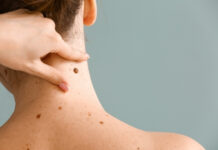 7 Types of Moles on Your Body That Could Signal Serious Health Issues Types of Moles on Your Body