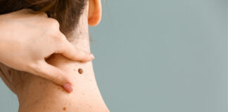 7 Types of Moles on Your Body That Could Signal Serious Health Issues Types of Moles on Your Body
