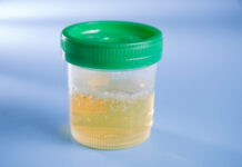 Foamy Urine: What It Means About Your Kidney Health Foamy Urine What It Means About Your Kidney Health