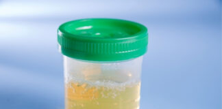 Foamy Urine: What It Means About Your Kidney Health Foamy Urine What It Means About Your Kidney Health
