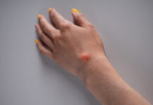 Hard Lump Under the Skin: Causes, Diagnosis, and When to Worry Hard Lump Under the Skin