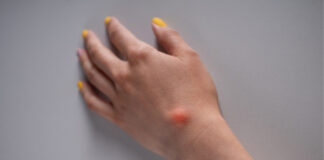 Hard Lump Under the Skin: Causes, Diagnosis, and When to Worry Hard Lump Under the Skin