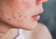 How to Fade Dark Spots From Pimples: Dermatologist-Approved Treatments How to Fade Dark Spots From Pimples