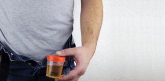 Why Is My Urine Brown? Causes, Symptoms, and When to See a Doctor Why Is My Urine Brown Causes Symptoms and When to See a Doctor