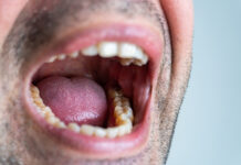 Dry Mouth at Night: Causes, Symptoms, and Solutions Dry Mouth at Night Causes Symptoms and Solutions