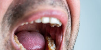 Dry Mouth at Night: Causes, Symptoms, and Solutions Dry Mouth at Night Causes Symptoms and Solutions