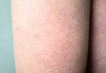 Effective Home Remedies for Keratosis Pilaris Effective Home Remedies for Keratosis Pilaris