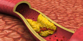 High Cholesterol but Healthy: When Statins Might Not Be Enough High Cholesterol but Healthy When Statins Might Not Be Enough