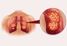 Small Cell vs Non-Small Cell Lung Cancer: Key Differences Small-Cell-vs-Non-Small-Cell-Lung-Cancer