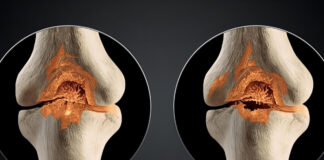 Stress Fracture vs. Hairline Fracture: What’s the Difference? Stress Fracture vs Hairline Fracture Whats the Difference