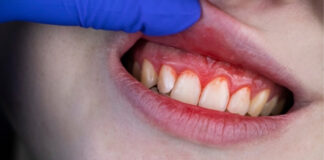 Why Do My Gums Bleed When I Brush? Causes and Remedies Why Do My Gums Bleed When I Brush