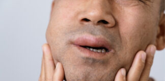 How to Reduce Angioedema Swelling: Home Remedies and Medical Treatments That Help How to Reduce Angioedema Swelling