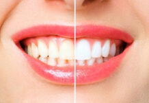 Professional Whitening vs. At-Home Kits: Which Option Is Right for You? Professional Whitening vs At-Home Kits