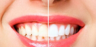 Professional Whitening vs. At-Home Kits: Which Option Is Right for You? Professional Whitening vs At-Home Kits