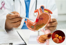 Strategies to Reduce Your Stomach Cancer Risk During Awareness Month Strategies to Reduce Your Stomach Cancer Risk During Awareness Month