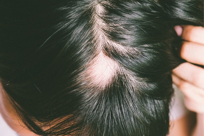 Frontal Fibrosing Alopecia: Recognising the Early Signs & Latest Treatment Advances Frontal Fibrosing Alopecia