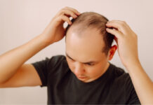 Lifestyle & Nutrition Factors in Alopecia: What Science Says You Can Control Lifestyle Nutrition Factors in Alopecia