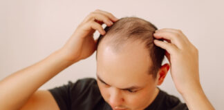 Lifestyle & Nutrition Factors in Alopecia: What Science Says You Can Control Lifestyle Nutrition Factors in Alopecia