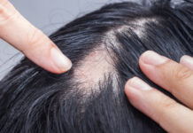 Scarring Alopecia (Cicatricial Alopecia): When Hair Loss Is Permanent – What You Should Know Scarring Alopecia