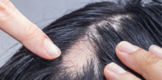 Scarring Alopecia (Cicatricial Alopecia): When Hair Loss Is Permanent – What You Should Know Scarring Alopecia