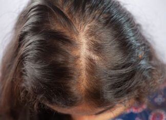 Traction Alopecia: How Hairstyles, Headwear & Habits Cause Hair Loss And How to Prevent It Traction Alopecia