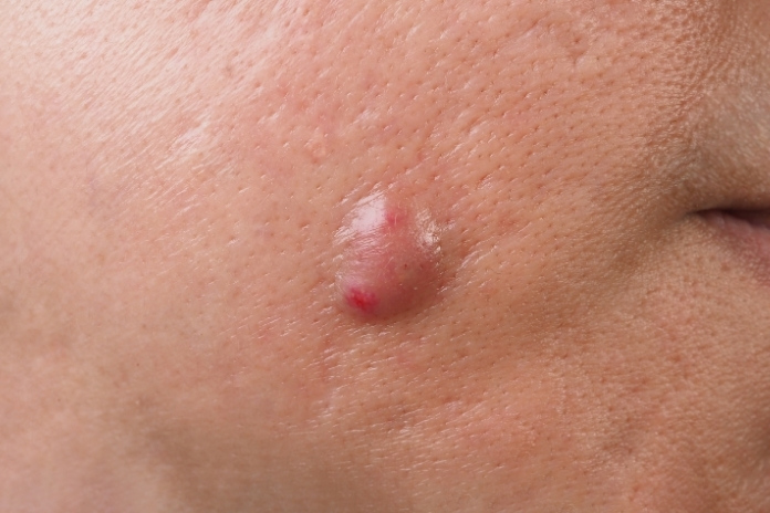 What Are the Early Signs of a Carbuncle and How to Know When It’s More Than a Boil What Are the Early Signs of a Carbuncle and How to Know When Its More Than a Boil