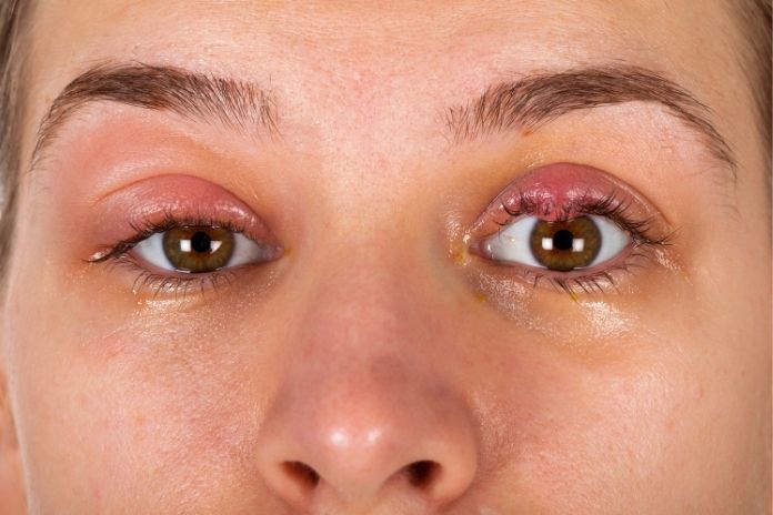 What Is a Chalazion? Symptoms, Causes & How It’s Treated What Is a Chalazion