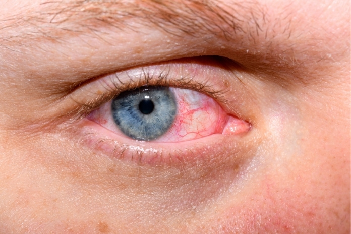 Dry Eye Syndrome vs. Allergic Conjunctivitis: How to Tell the Difference & What to Do Dry Eye Syndrome vs Allergic Conjunctivitis