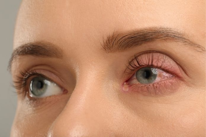 Treatment for Allergic Conjunctivitis