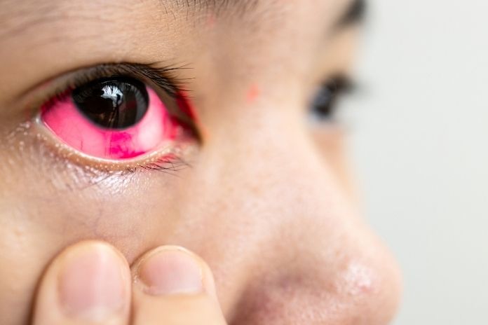 What Is Allergic Conjunctivitis