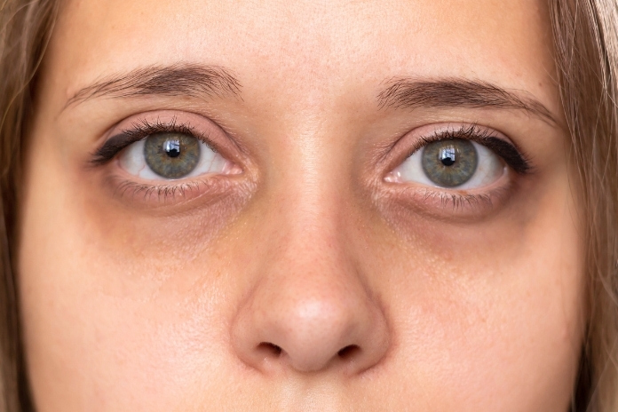 Why Your Dark Circles Look Purple-And the 3 Nutrients You Might Be Missing Why Your Dark Circles Look Purple