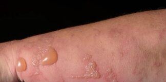 When to Go to the ER: A Parent’s Guide to Severe Phytophotodermatitis Blistering in Children A Parent’s Guide to Severe Phytophotodermatitis Blistering in Children