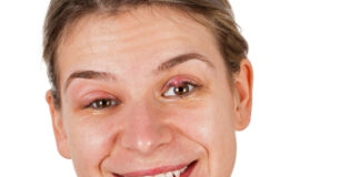 Chalazion vs. Stye: How to Tell the Difference and When to See a Doctor Chalazion vs Stye