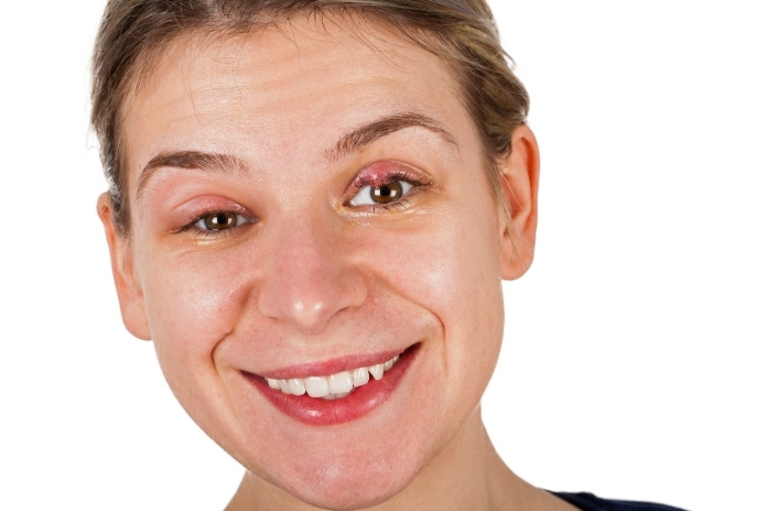 Chalazion vs Stye Chalazion vs Stye