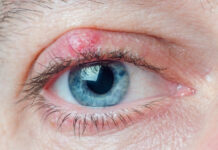 How Long Does a Chalazion Last? Timeline, Stages & Recovery Tips How Long Does a Chalazion Last